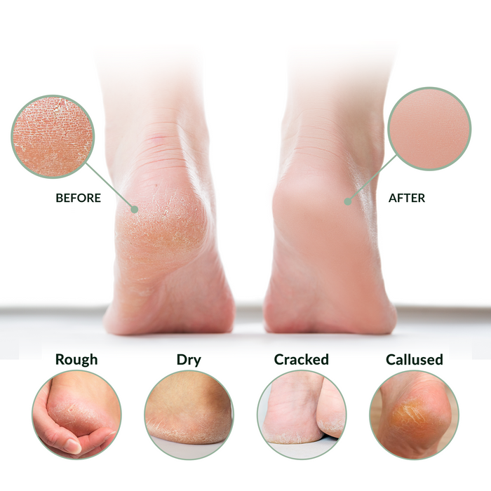 The image shows a comparison of heels before and after treatment, highlighting improvements in skin texture. The "before" heel appears rough, dry, cracked, and callused, while the "after" heel looks smooth and healthy. Also shown are close-ups of heels
