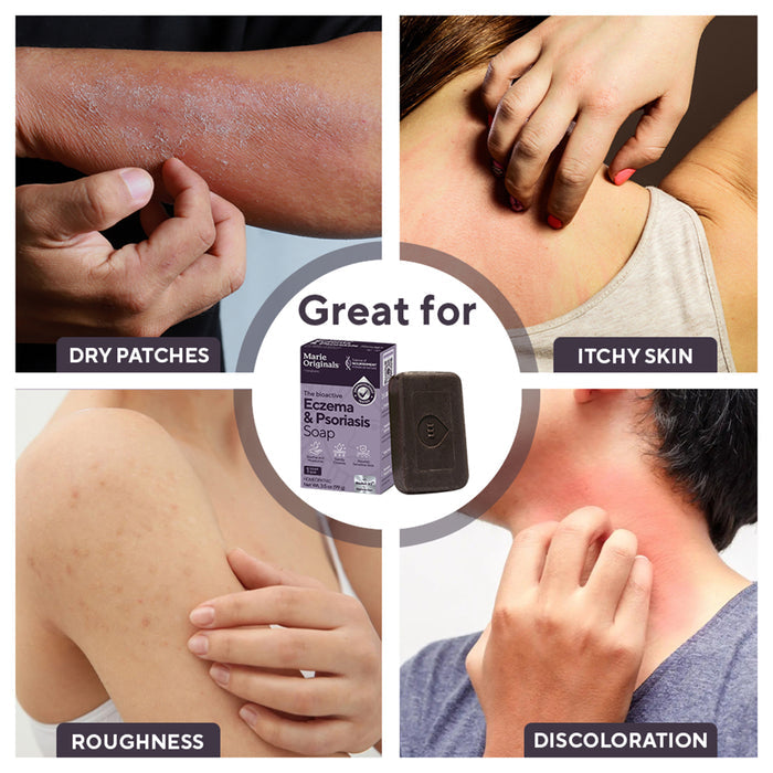 A collage features four people with dry patches, itchy skin, roughness, and discoloration—each examining or scratching their skin. At the center is Marie Originals Eczema & Psoriasis Relief Soap, a natural bar for symptom relief.