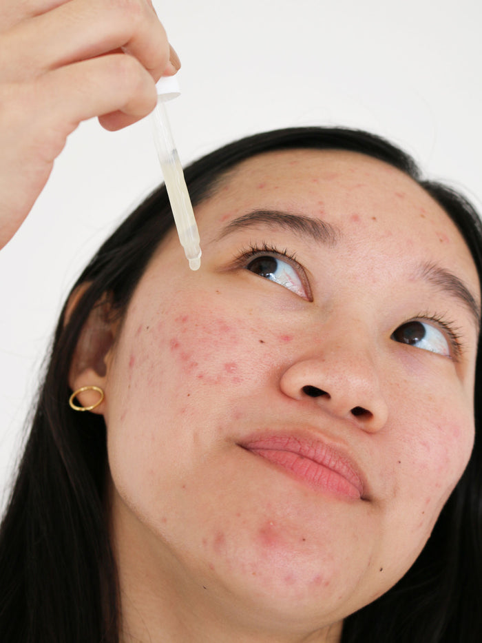 With dark hair and a gold hoop earring, a person with visible acne uses a dropper to apply Cocokinds Postbiotic Acne Serum to their face, gazing slightly upward against a plain, light-colored background.