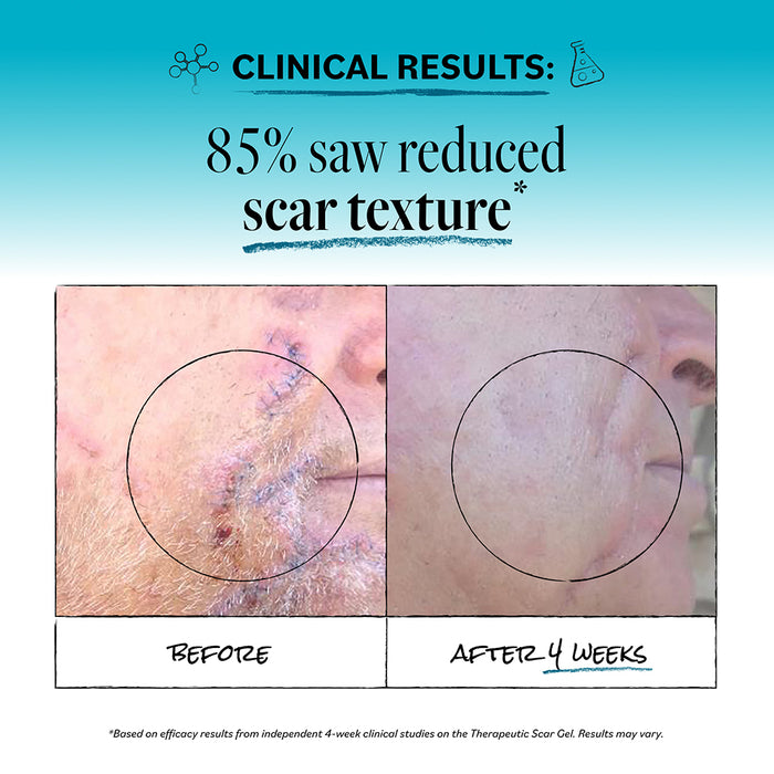 Side-by-side photos of a person’s cheek show reduced scar texture after 4 weeks, with a visible improvement noted in the after image. Text above states 85% saw reduced scar texture using Derma E Scar Gel to improve scar appearance.