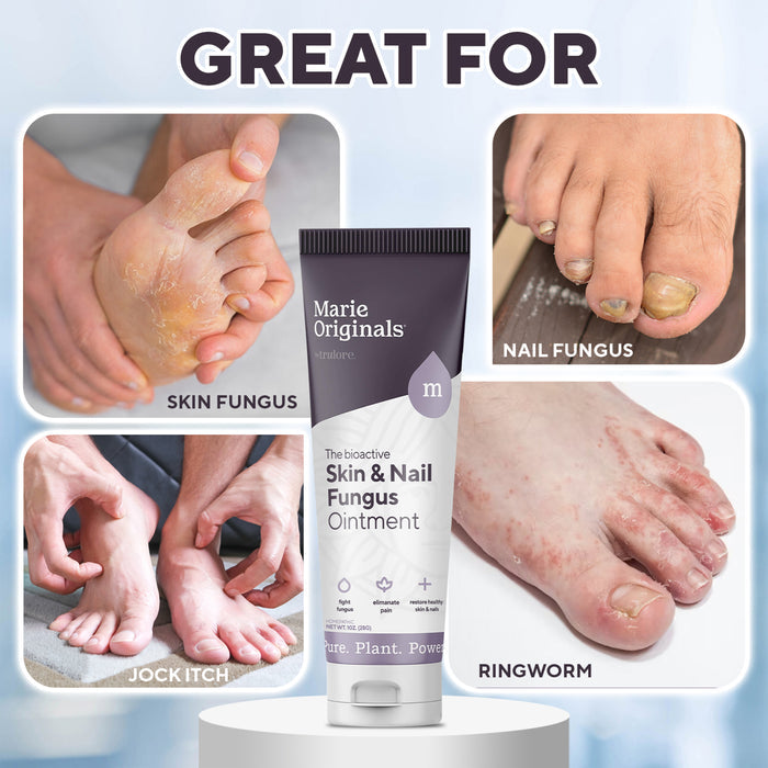 A tube of Marie Originals Skin & Nail Fungus Removal Cream is shown alongside images labeled skin fungus, nail fungus, jock itch, and ringworm to highlight its use as a treatment for various fungal infections.