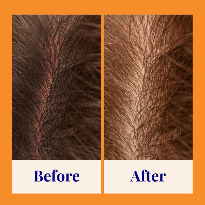 A split image reveals a scalp transformation: Before shows sparse hair and a wide part line, while After showcases fuller coverage. An orange border outlines the change, labeled below. Achieve balanced results with Strengthening & Soothing Powder Shampoo by The Powder Shampoo, enriched with botanical ingredients.